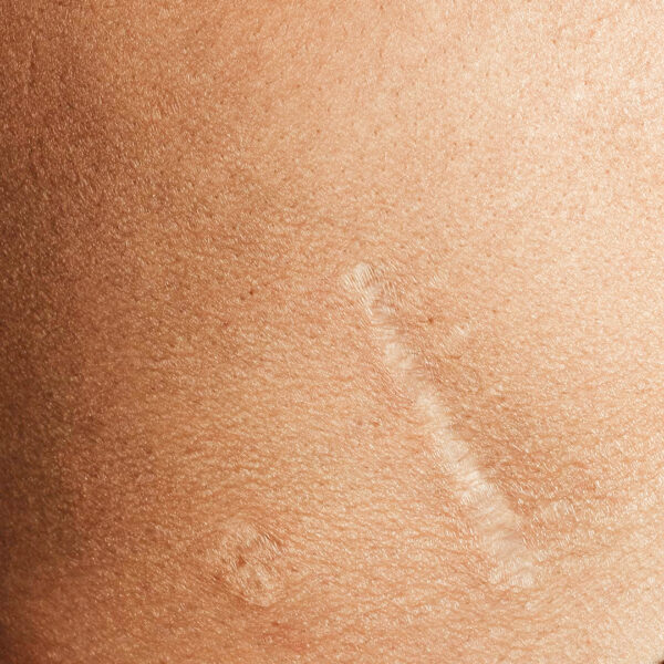 Terapia blizn Warszawa